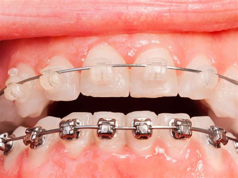 metal vs ceramic brackets|problems with ceramic braces.